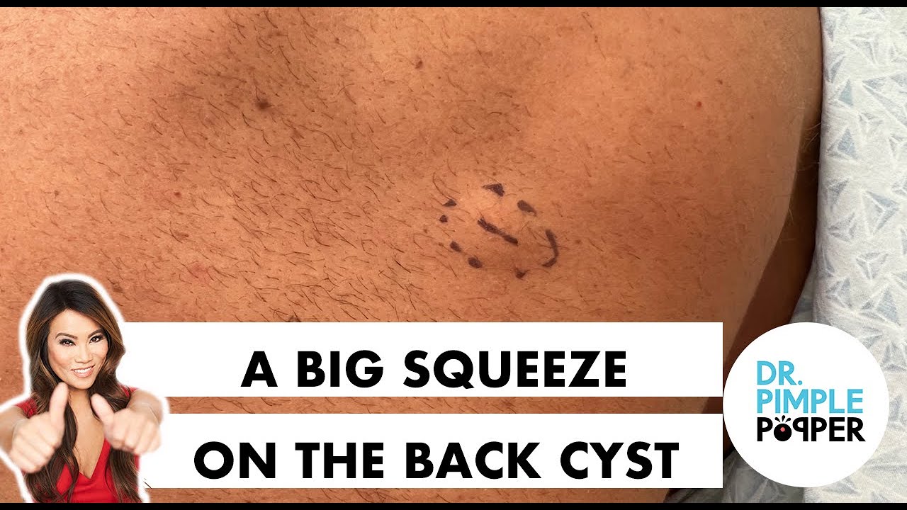 A Big Squeeze Cyst