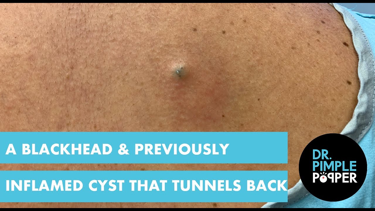 A Blackhead & A Previously Inflamed Cyst that Tunnels Back