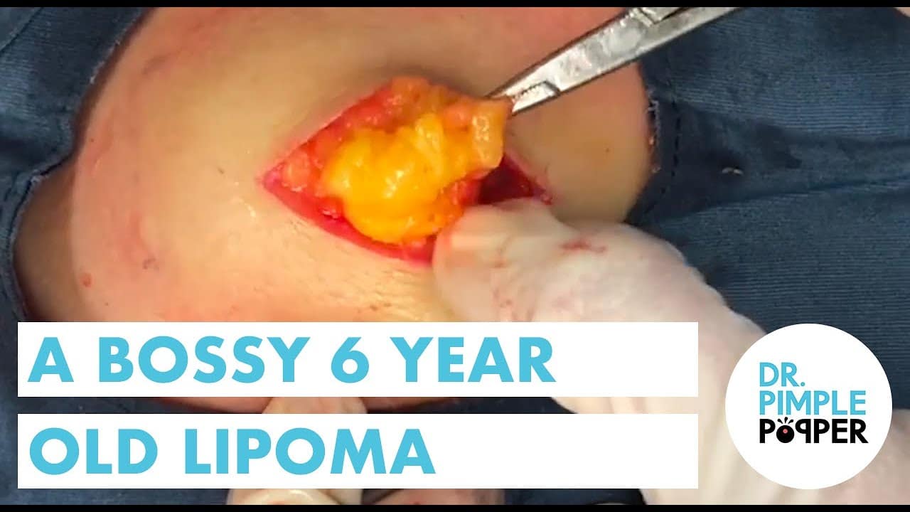 A Bossy 6 Year Old Lipoma