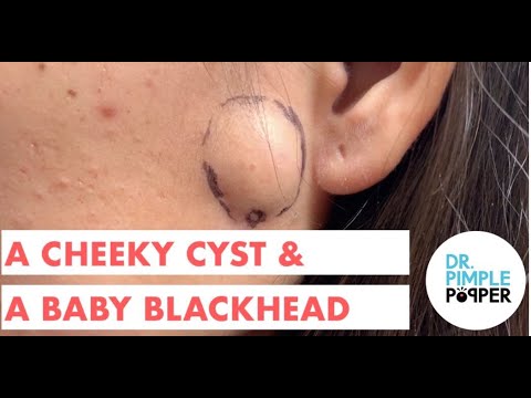 A Cheeky Cyst & A Baby Blackhead