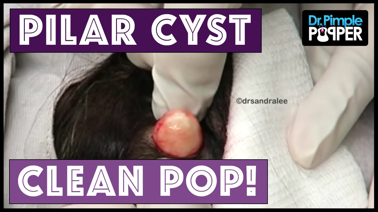 A Clean Pilar Cyst Pop!