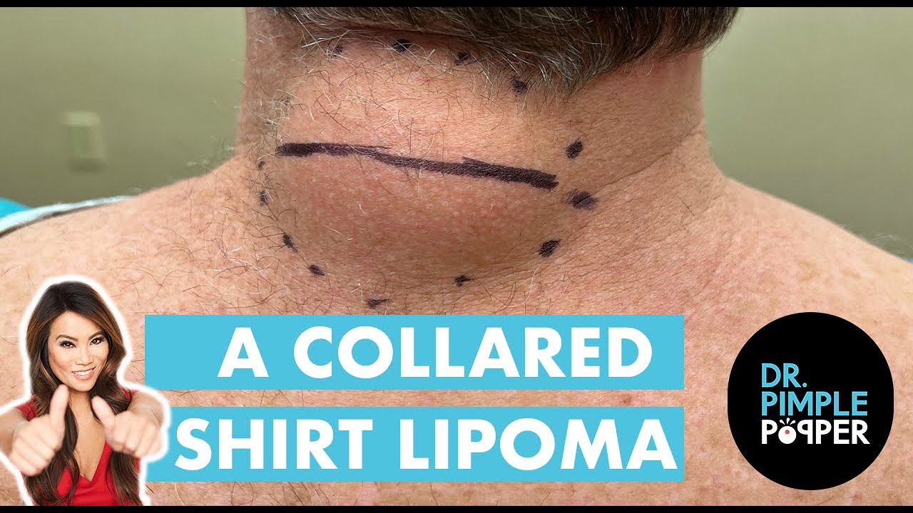 A Collared Shirt Lipoma