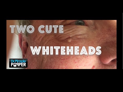 A couple of whiteheads extracted