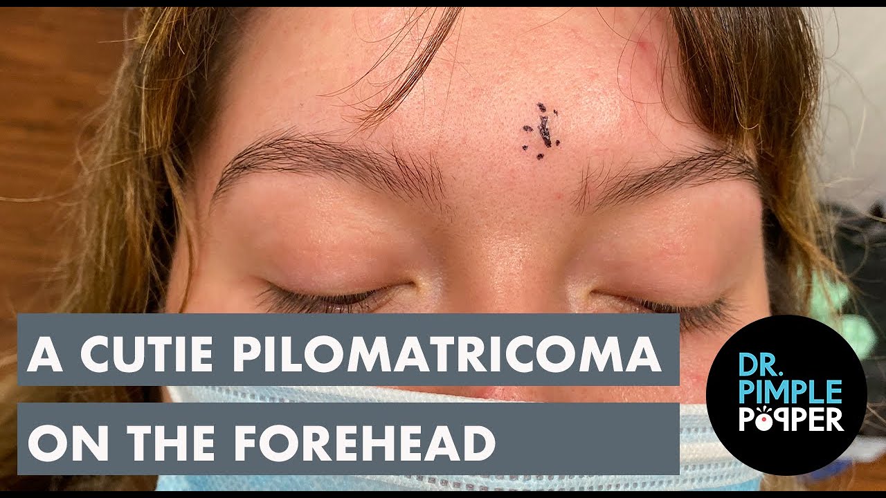 A Cutie Pilomatricoma on the Forehead