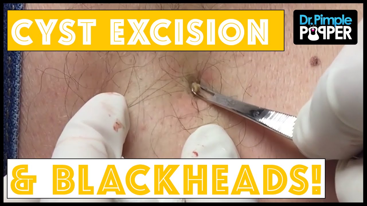 A Cyst Excision AND blackheads!
