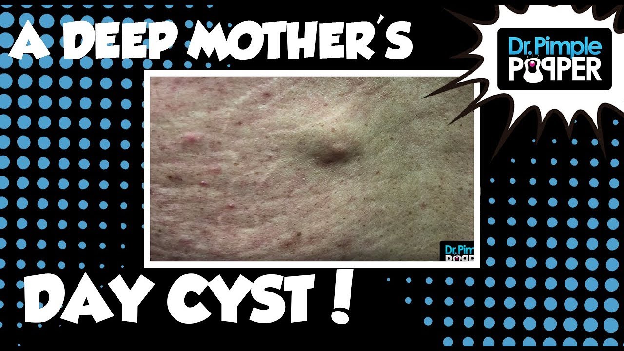 A Cyst for Mother’s Day