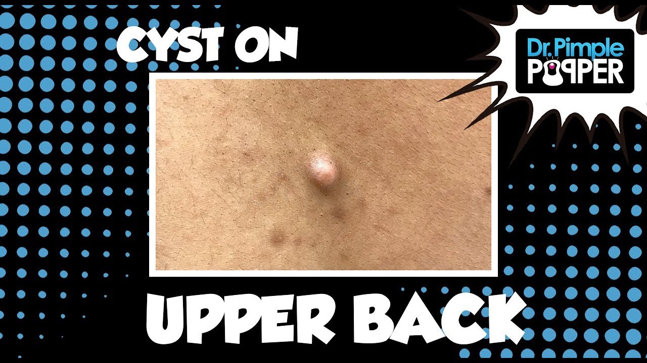 A Cyst on Top!