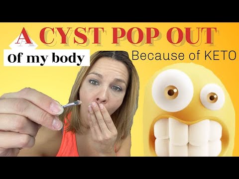 A CYST pop out of my body because of KETO!
