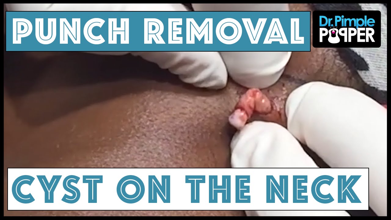 A Cyst Removed on the Left Neck Via Punch Biopsy Tool
