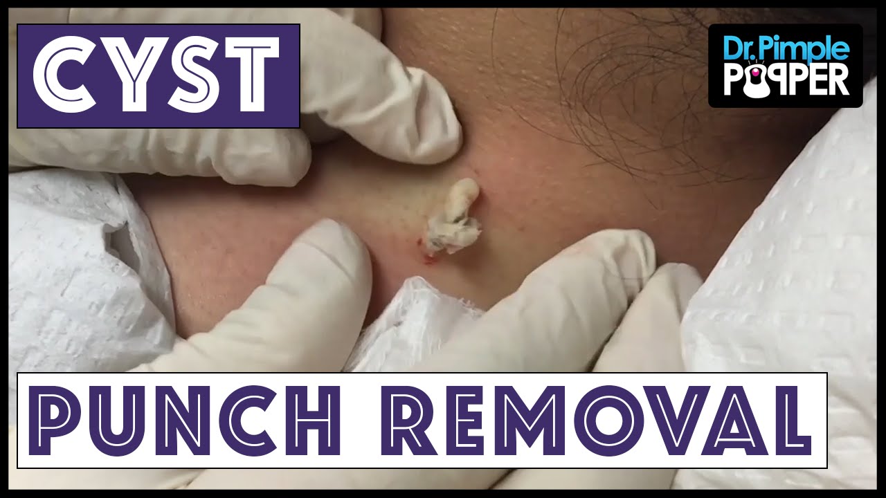 A Cyst Removed Via Punch on Left Neck