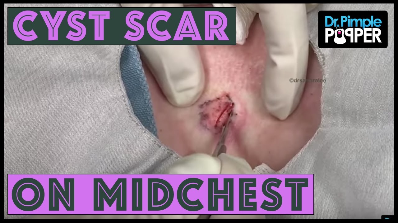 A Cyst Scar – Multiloculations on Midchest