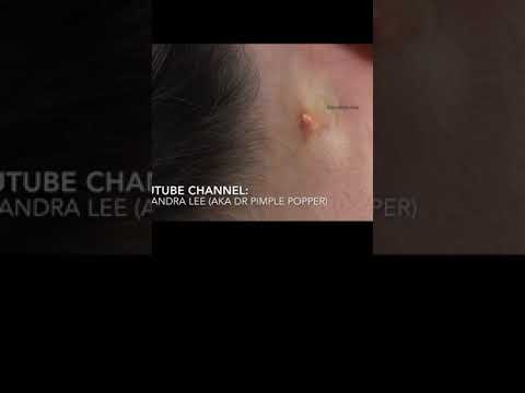A Cyst that never stops! 💥 | Dr. Pimple Popper #shorts #drpimplepopper