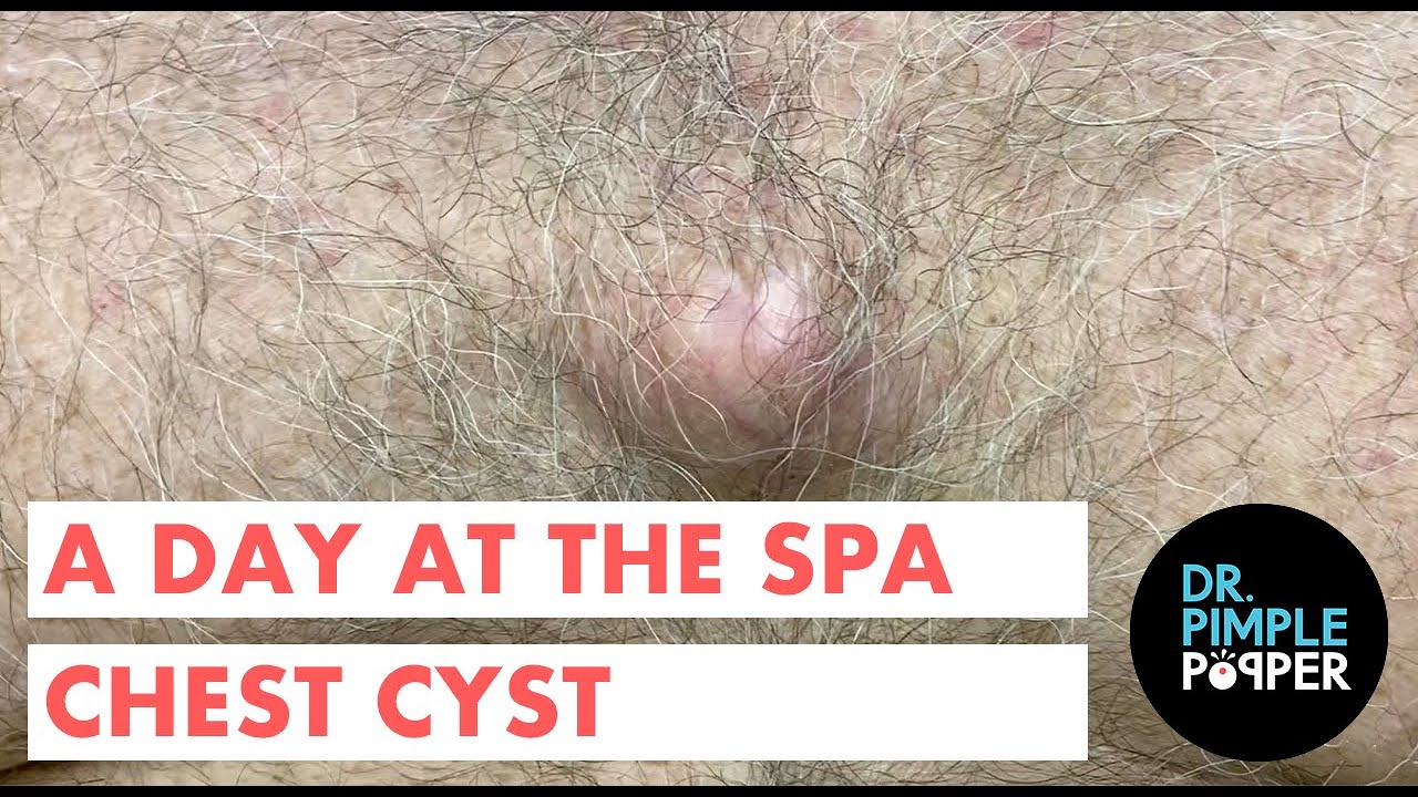 A Day At The Spa Chest Cyst