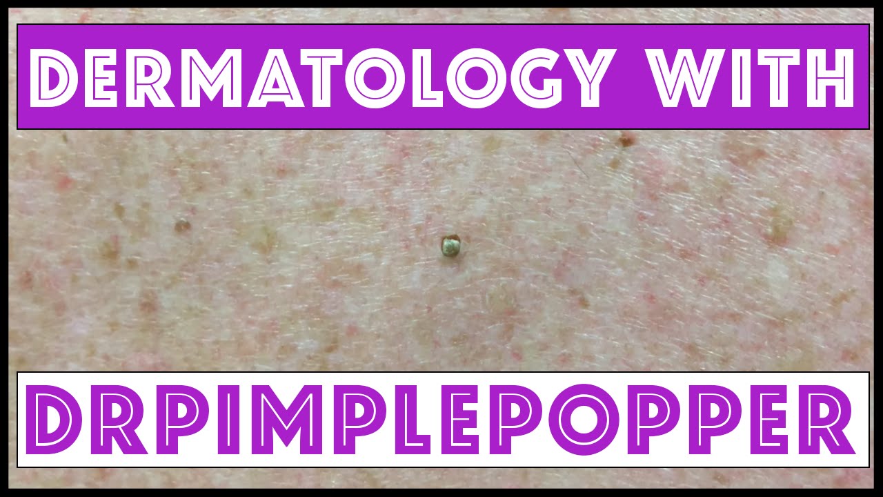 A Day in Dermatology with Dr Pimple Popper