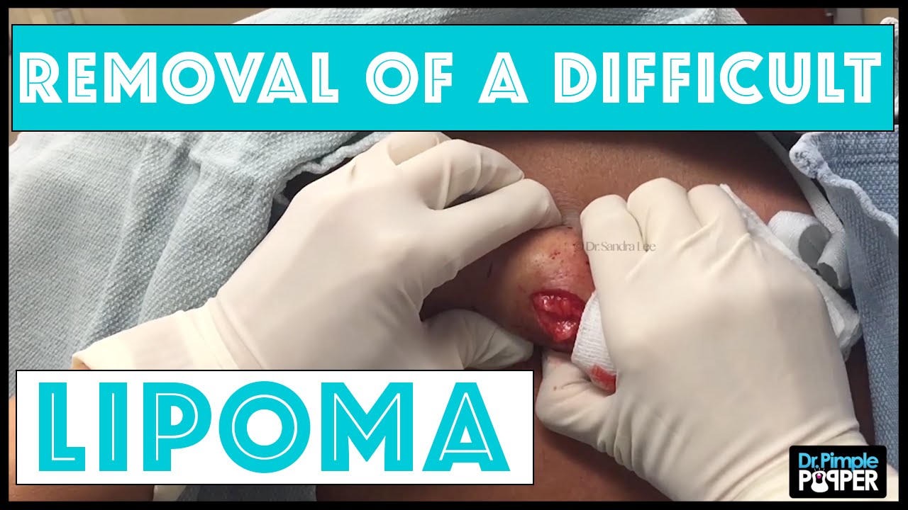 A Difficult Lipoma to remove from the Upper Back