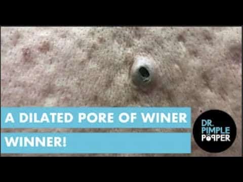 A Dilated Pore of Winer Winner!!