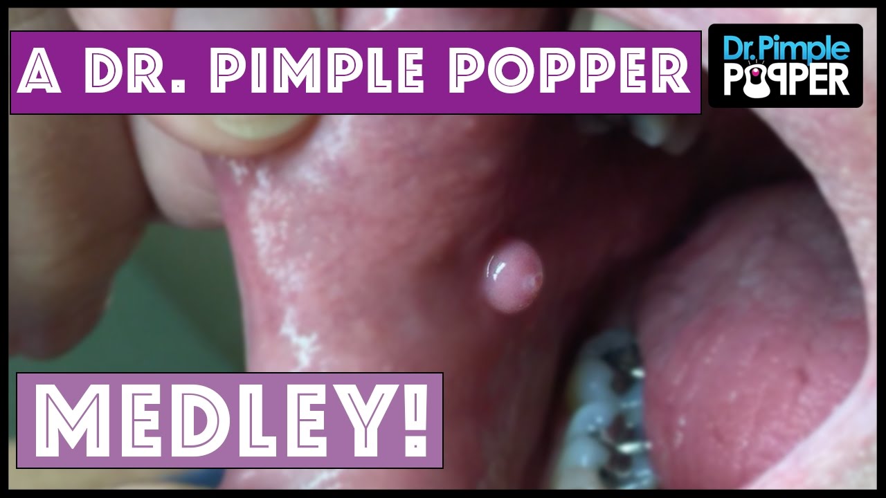 A Dr Pimple Popper Dermatology Medley
