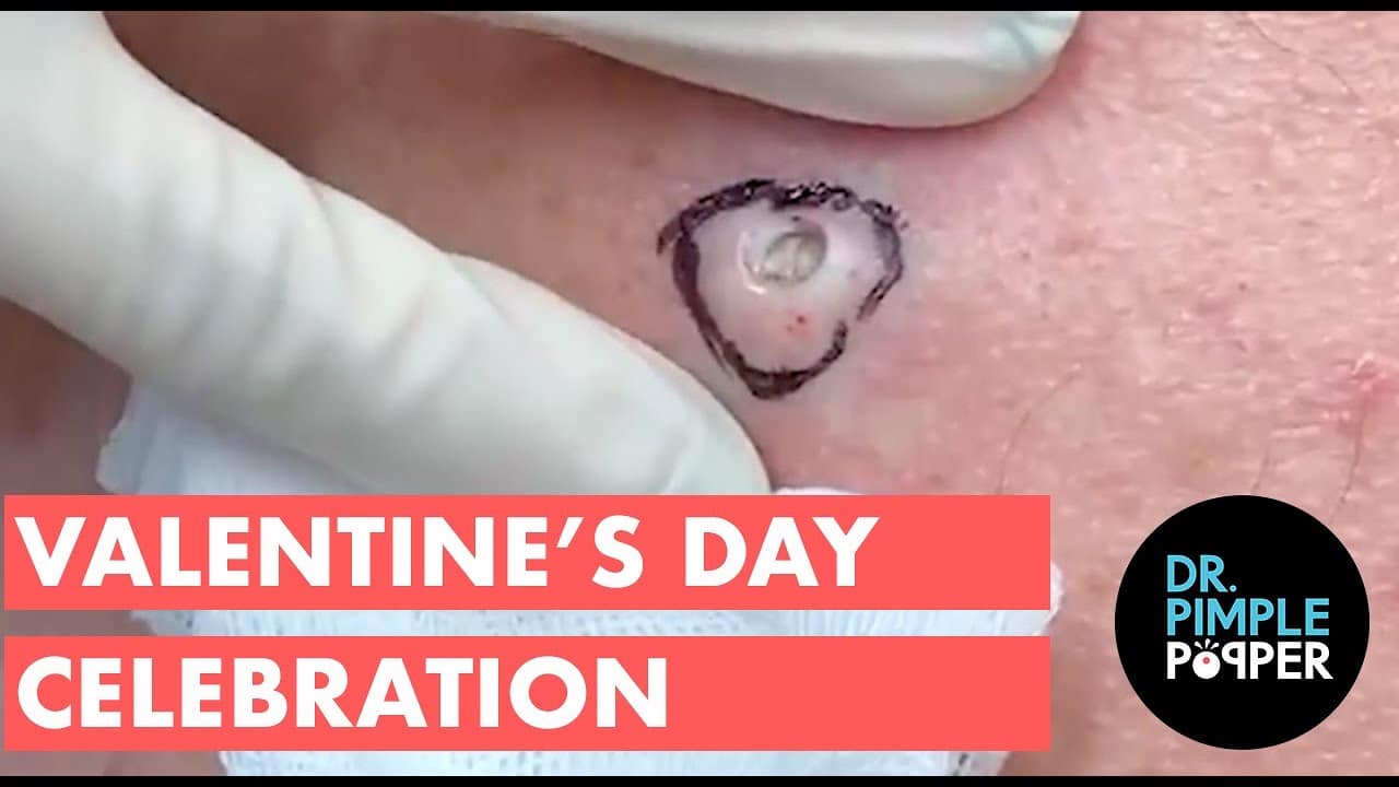 A Dr. Pimple Popper Valentine's Day Celebration!