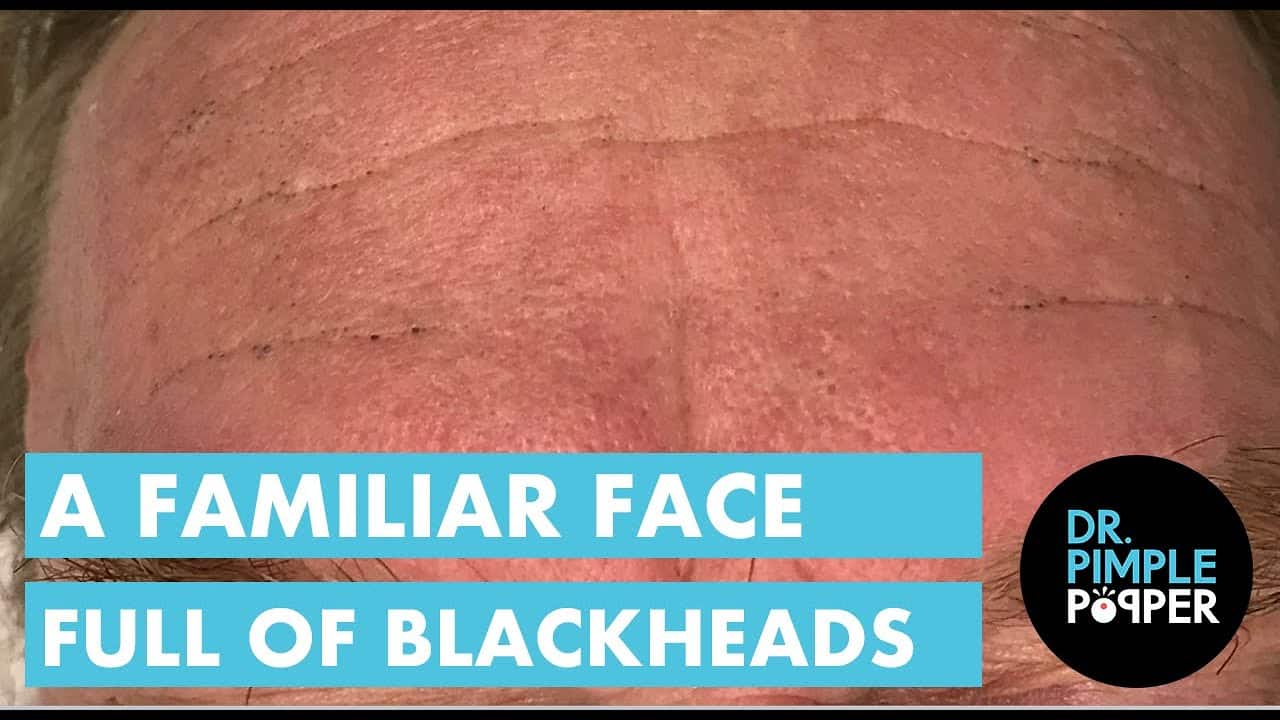 A Familiar Face Full of Blackheads