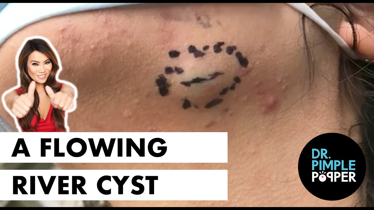 A Flowing River Cyst