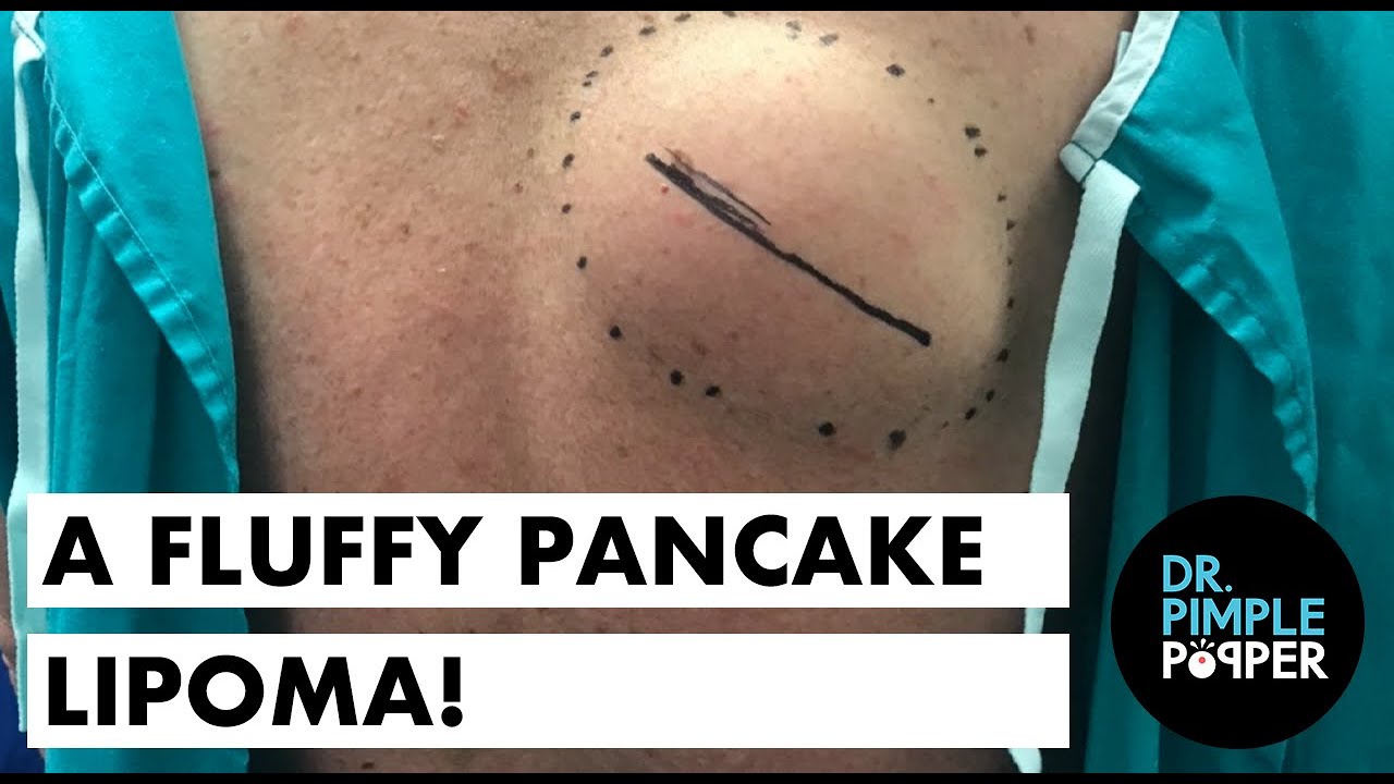 A Fluffy Pancake Lipoma
