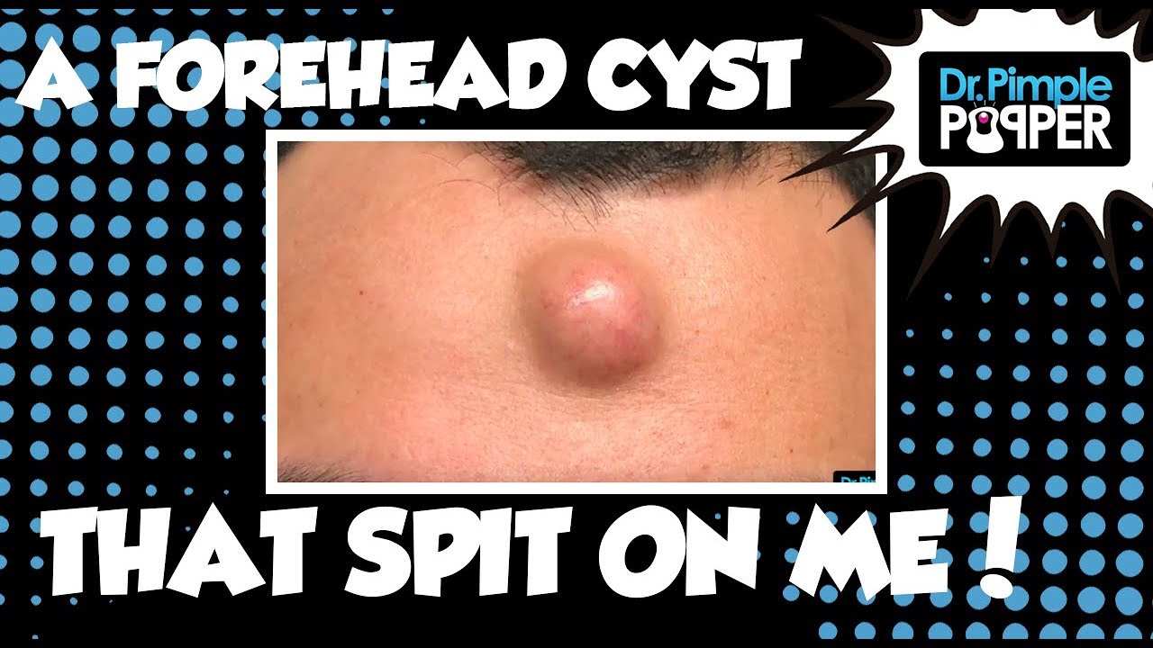 A Forehead Cyst That Spit On Me!