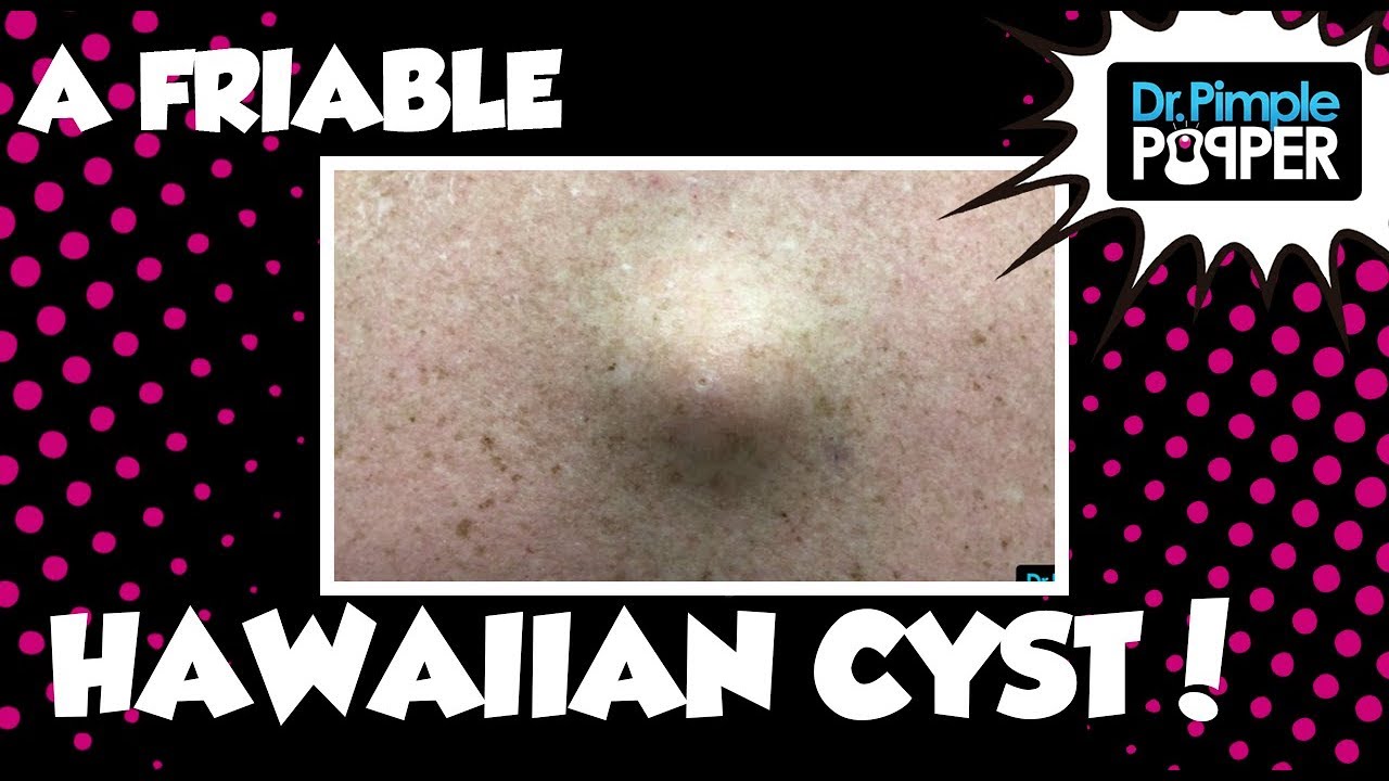 A Friable Hawaiian Cyst ?