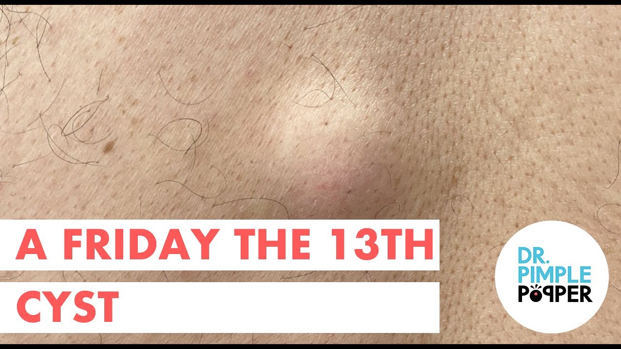 A Friday the 13th Cyst