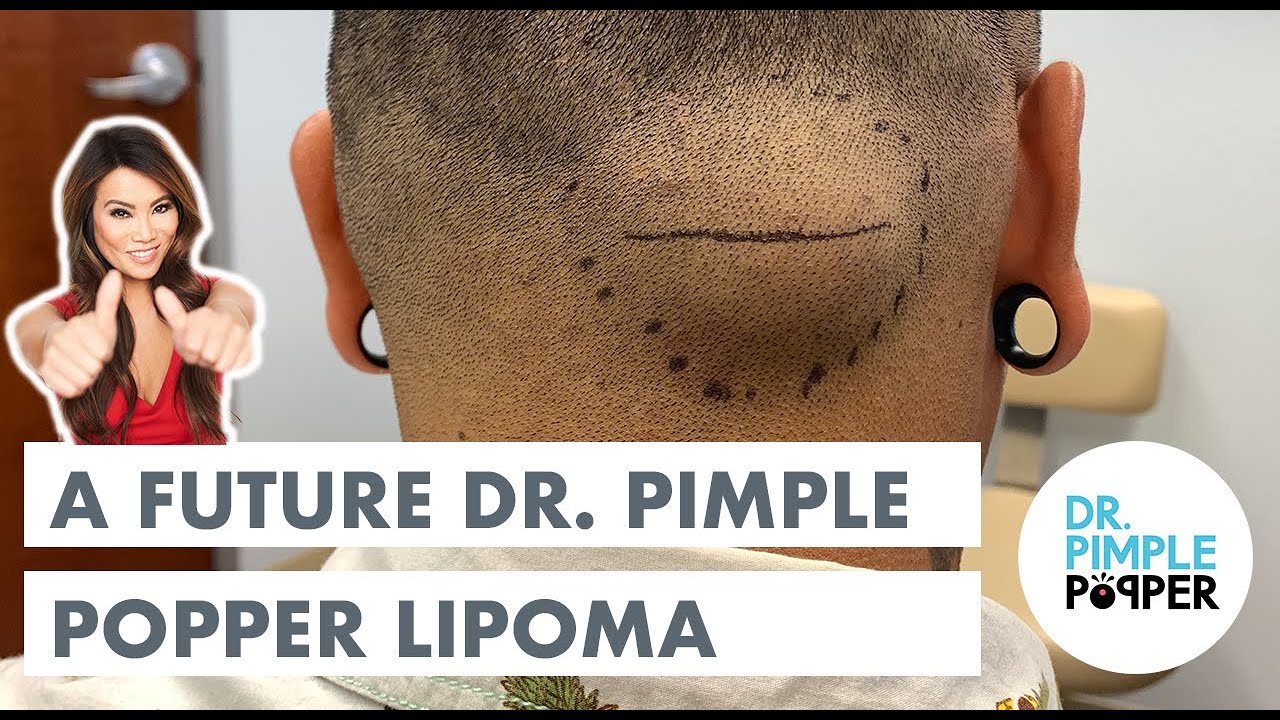 A Future Dr. Pimple Popper Lipoma
