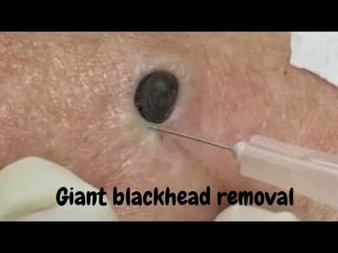 A giant blackhead extraction || stubborn Blackhead removal procedure