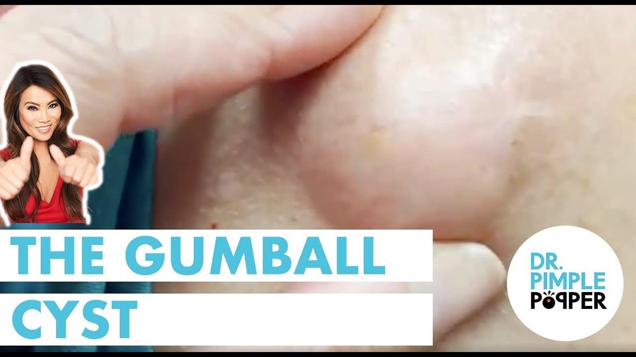 A Gumball Cyst