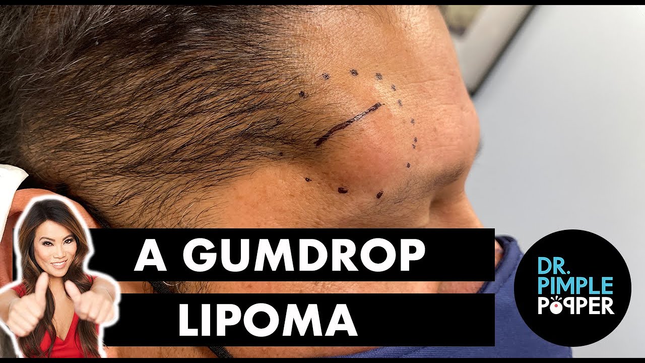 A Gumdrop Lipoma