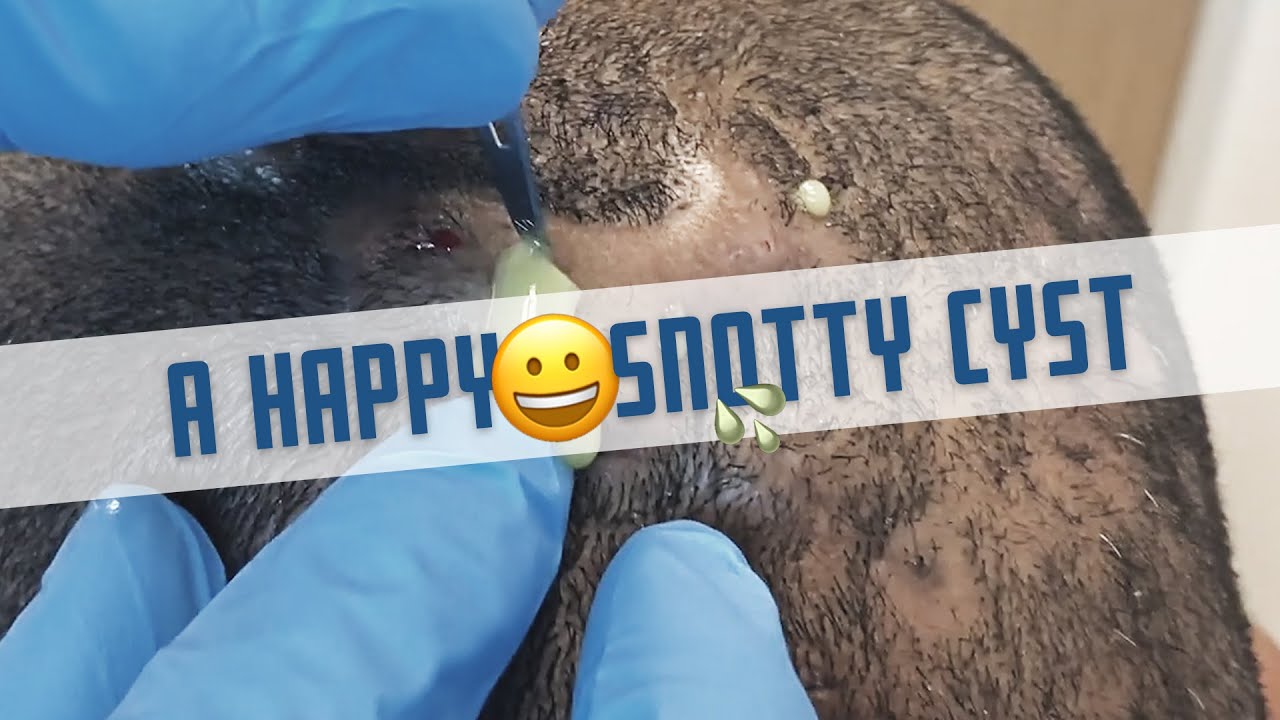 A Happy Snotty Cyst (Dissecting Cellulitis of the Scalp)
