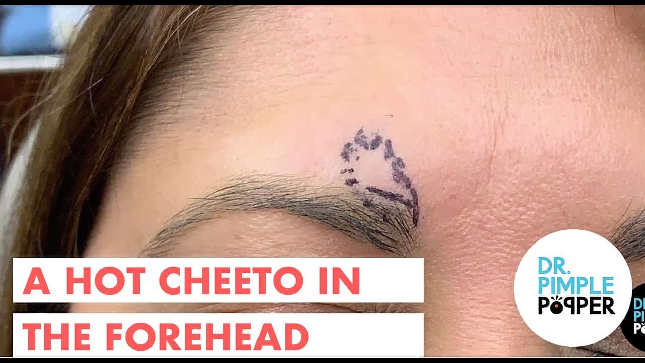 A Hot Cheeto in the Forehead