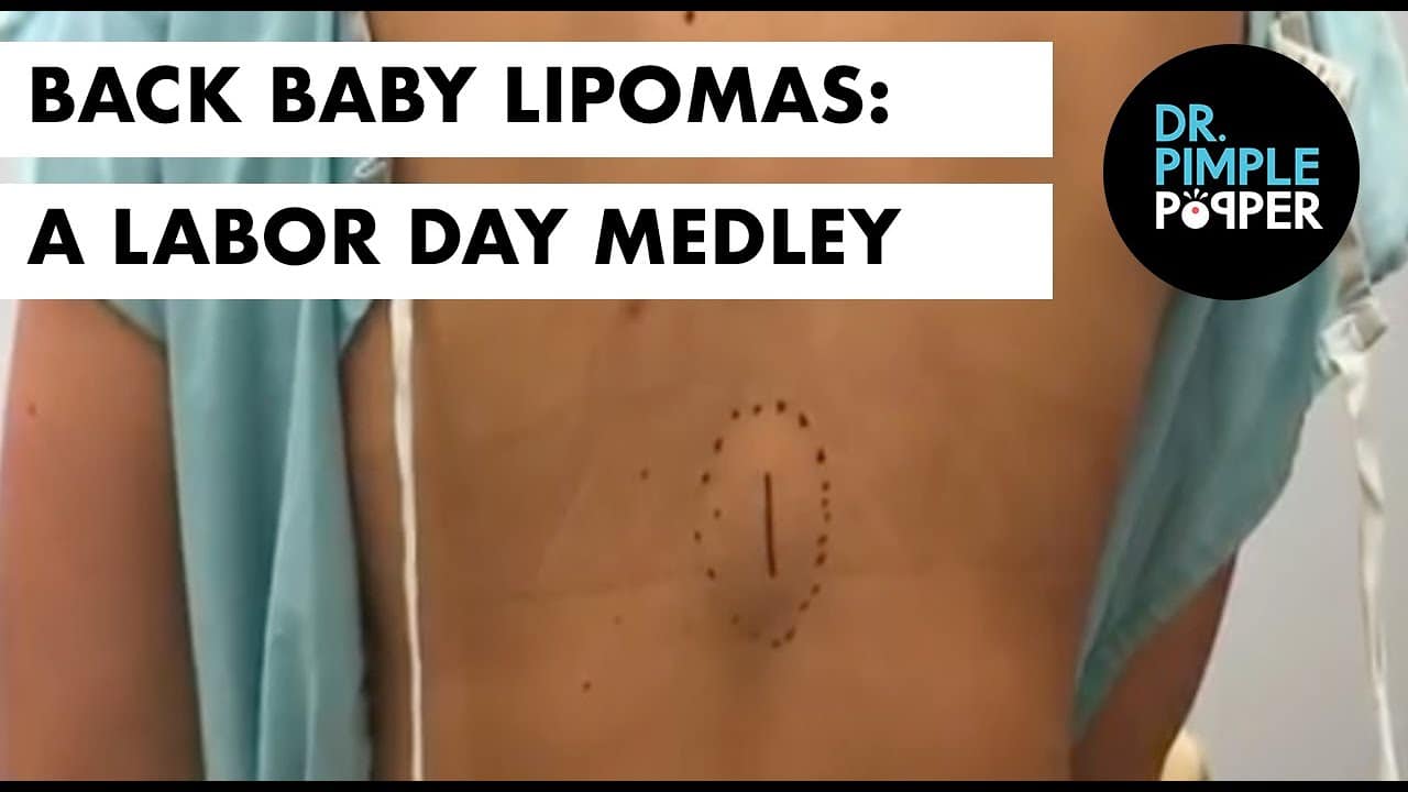 A Labor Day Medley: Back Baby Lipomas