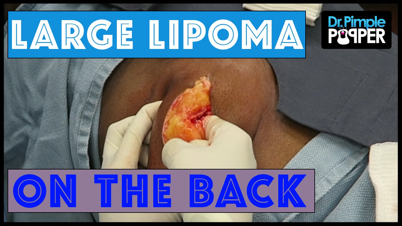 A Large Lipoma Excised on the Lower Back