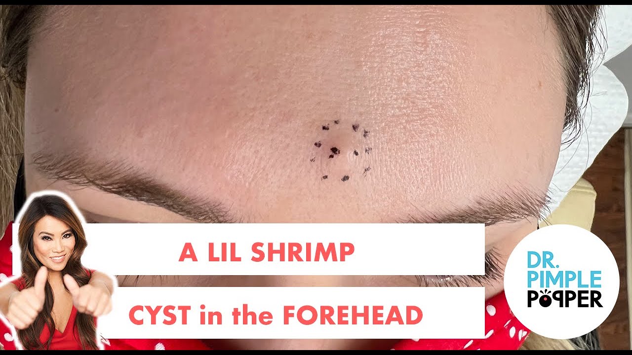 A Lil Shrimp Cyst in the Forehead
