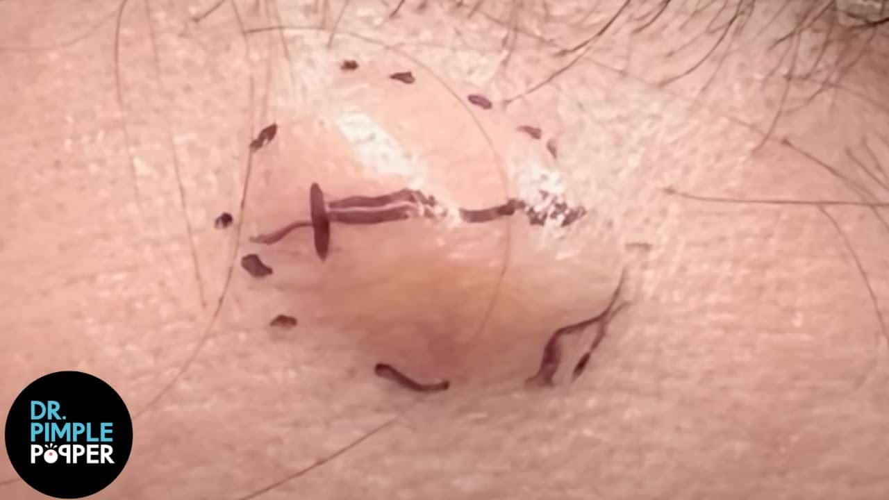 A Lima Bean Cyst You Have To See!