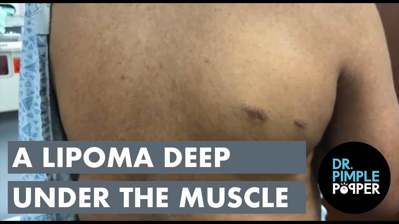 A Lipoma Deep Under The Muscle