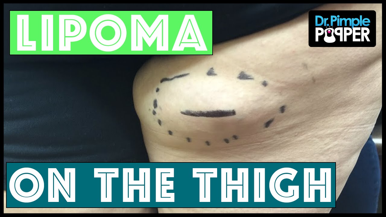 A Lipoma Excised from the Right Posterior Thigh on a Popaholic’s Mom!