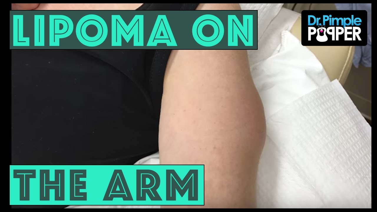 A Lipoma International on the Arm!