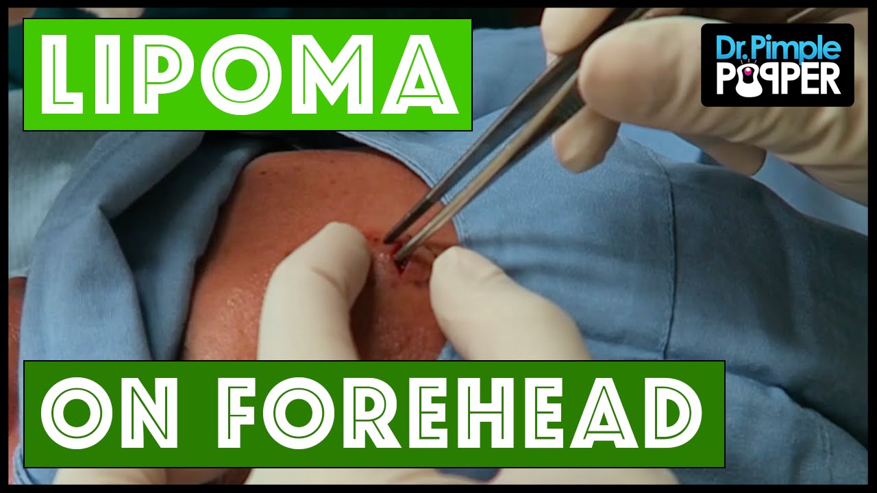 A lipoma on the forehead, excised: Dr Pimple Popper
