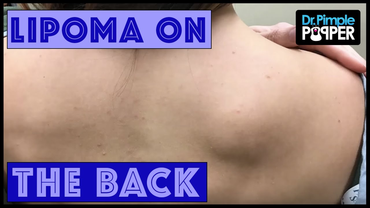 A Lipoma Removal in a Nervous Patient
