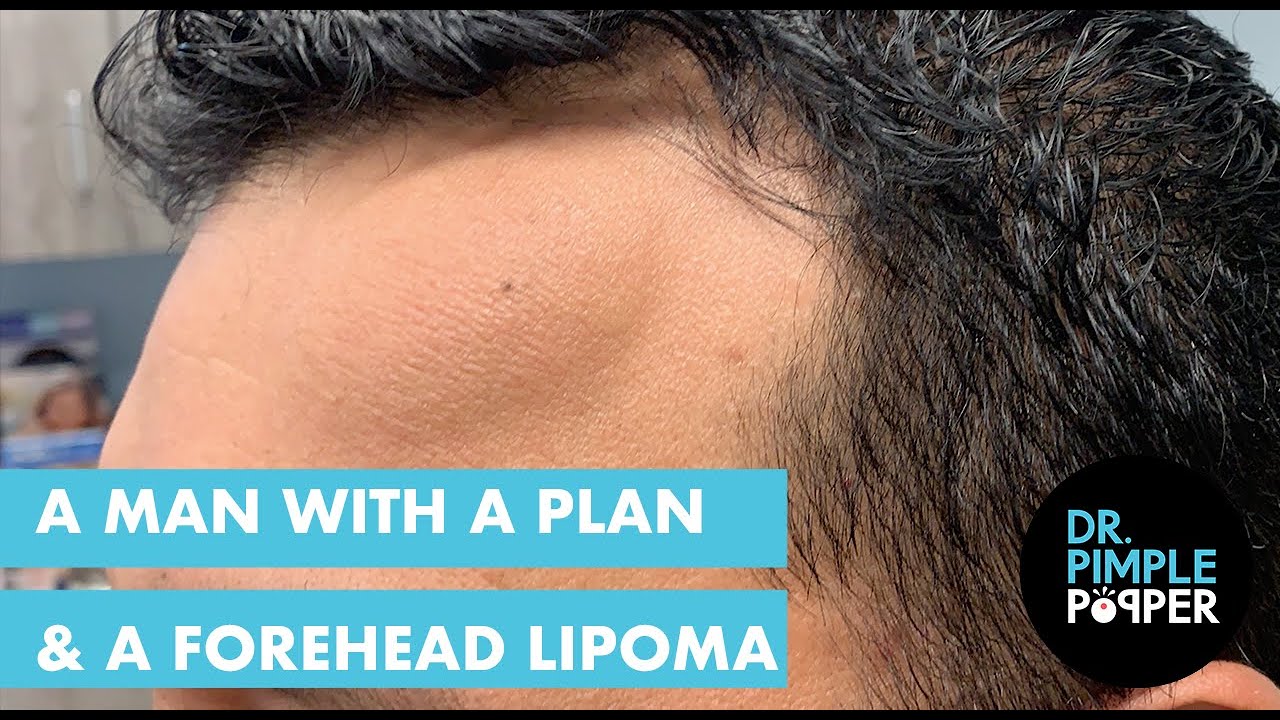 A Man with a Plan & A Forehead Lipoma