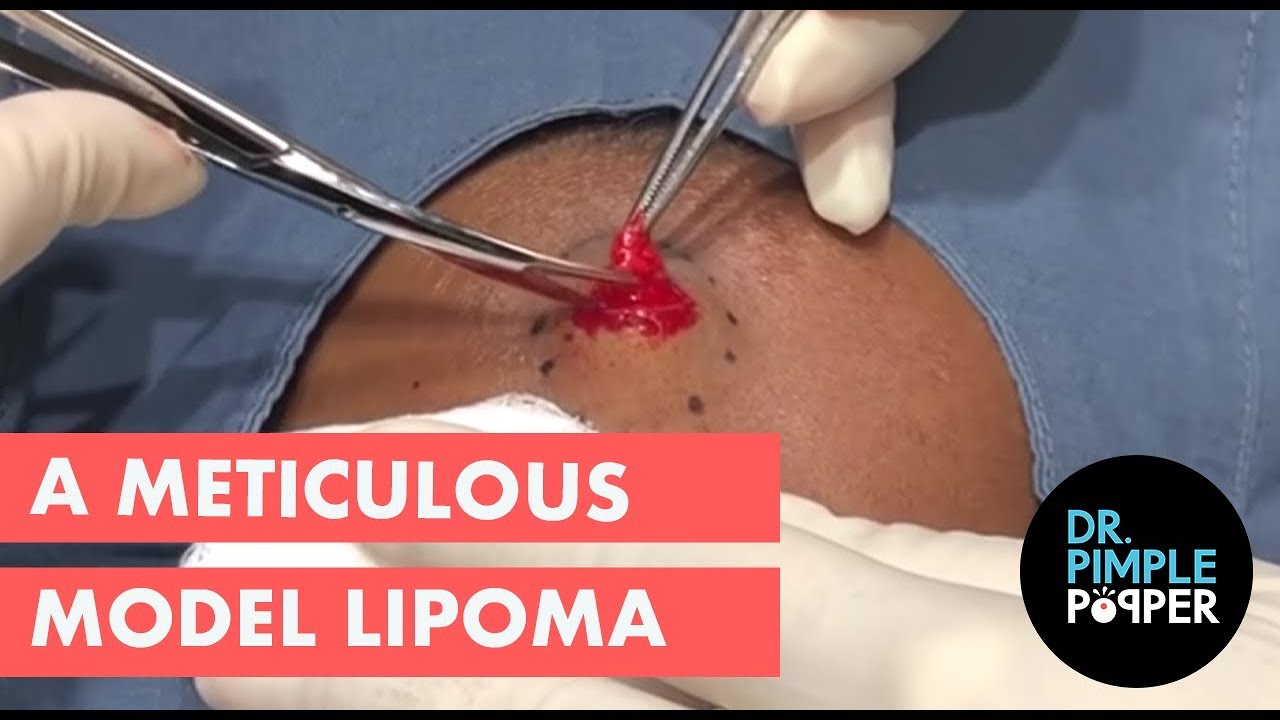 A meticulous model lipoma