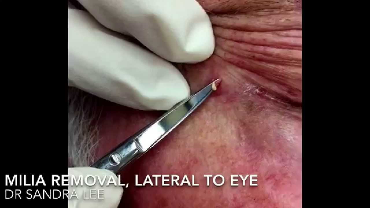 A Milia Medley, then a Dilated Pore of Winer. For medical education- NSFE.