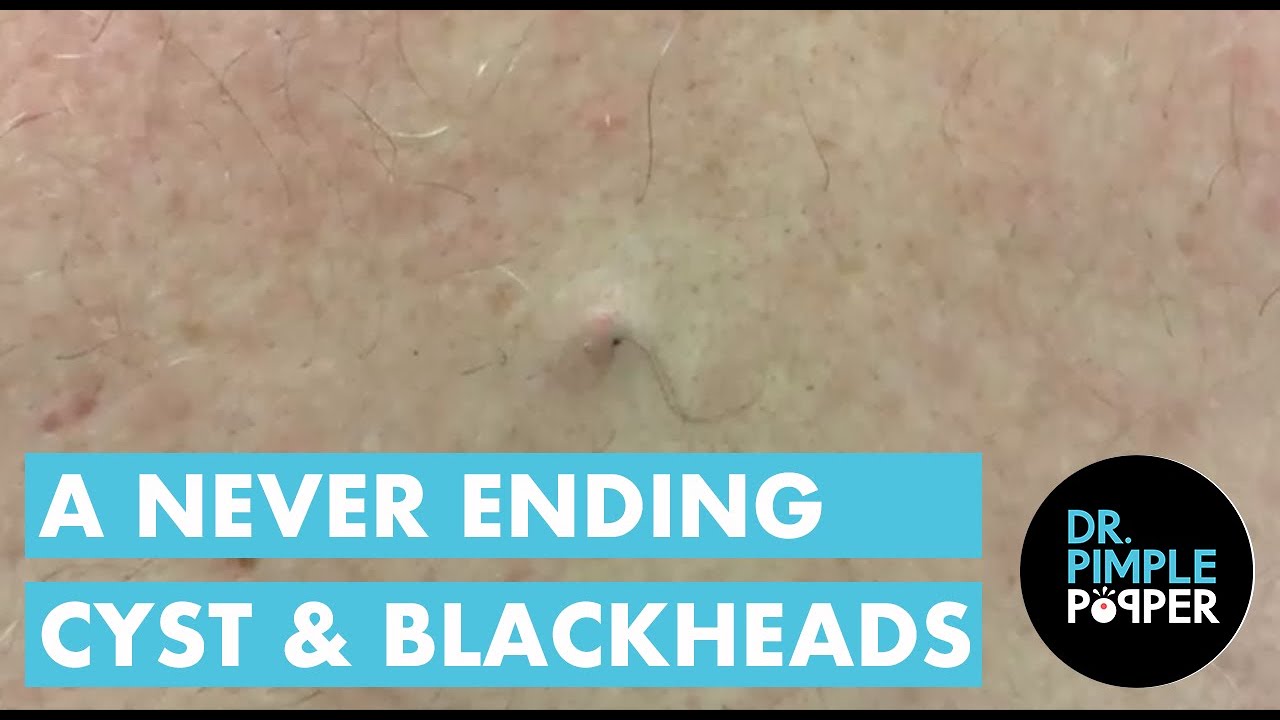A Never Ending Cyst and Blackheads