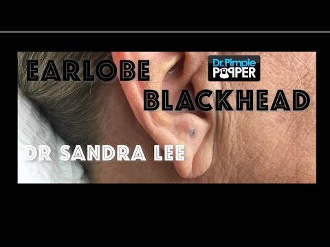 A nice earlobe blackhead extracted