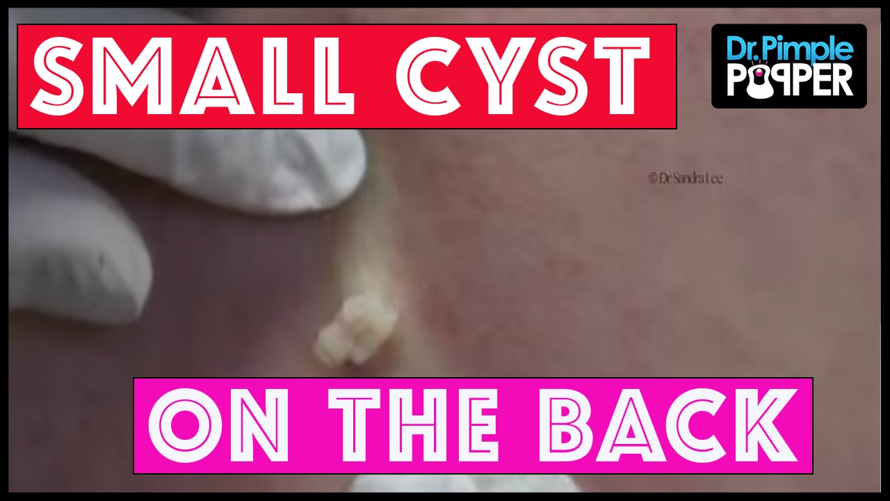 A Nice Little Punch to the Back… Cyst
