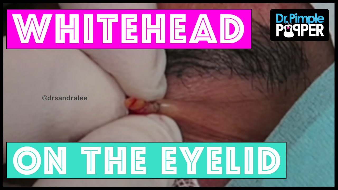 A Nice Little Whitehead Squeezed on the Upper Eyelid!